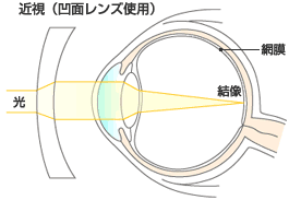 img_myopia02.gif