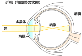 近視あ.gif