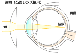 img_farsightedness02.gif